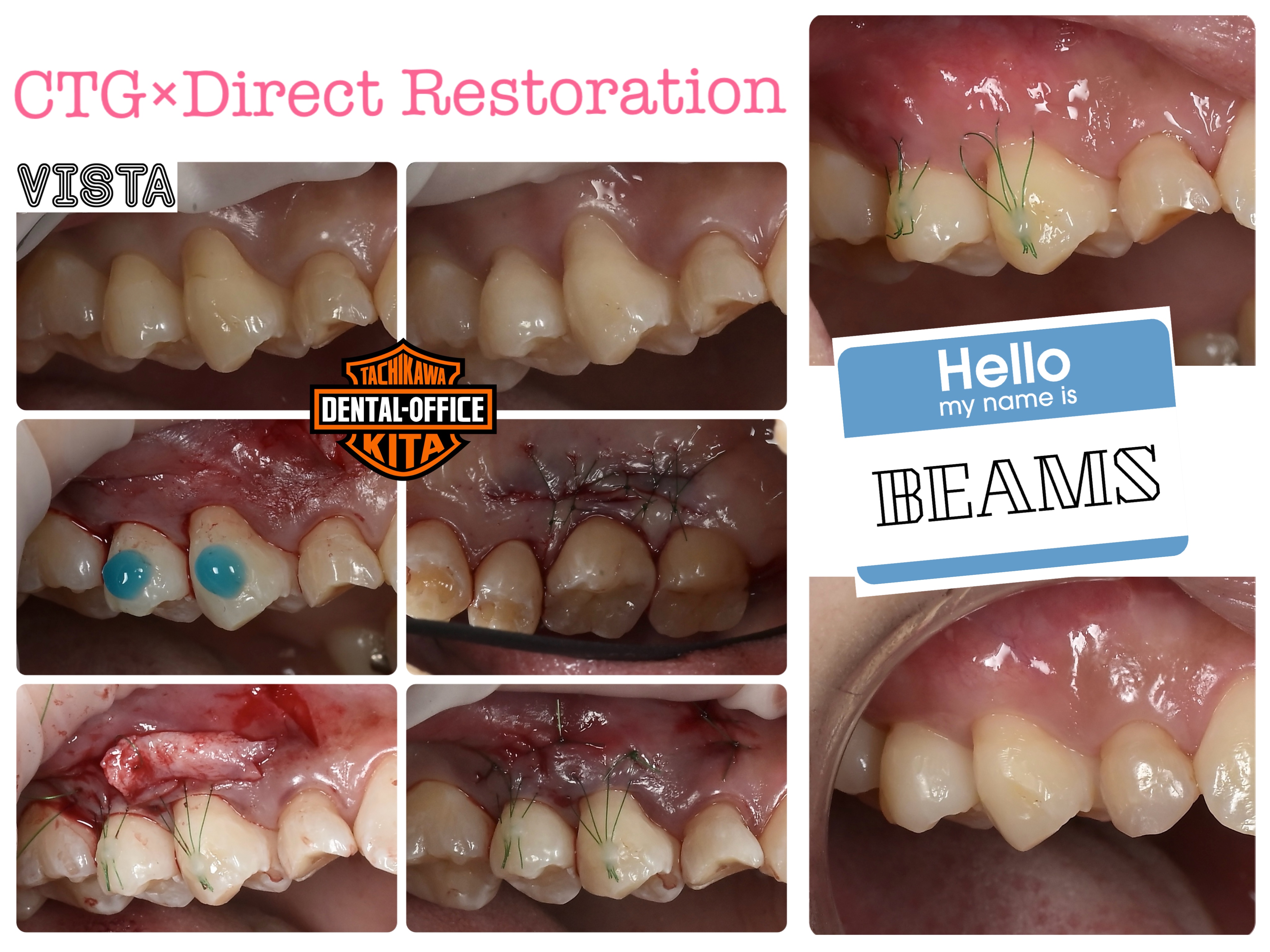 乳歯も残して歯茎も再生