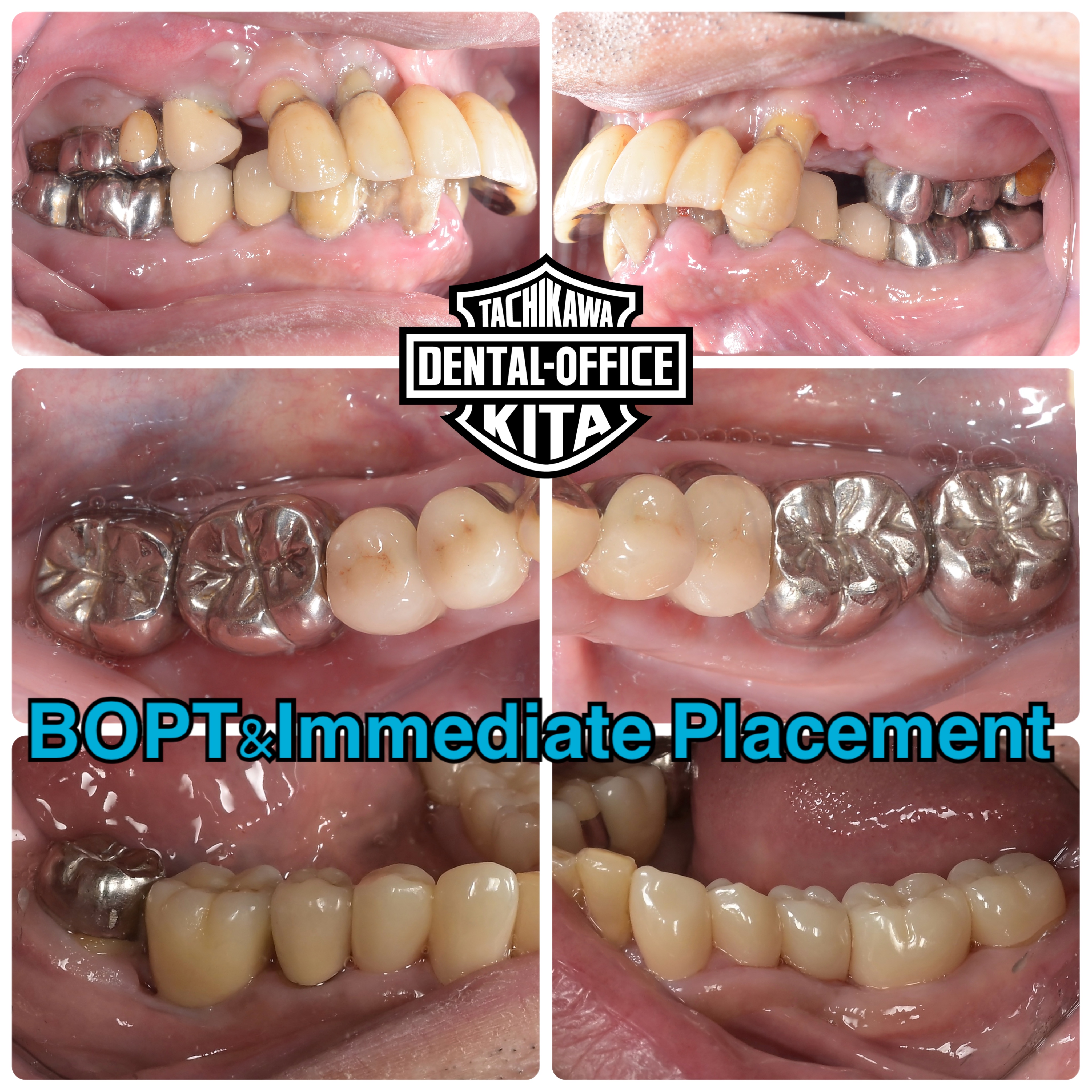 一時的にインプラント回避して補綴した症例