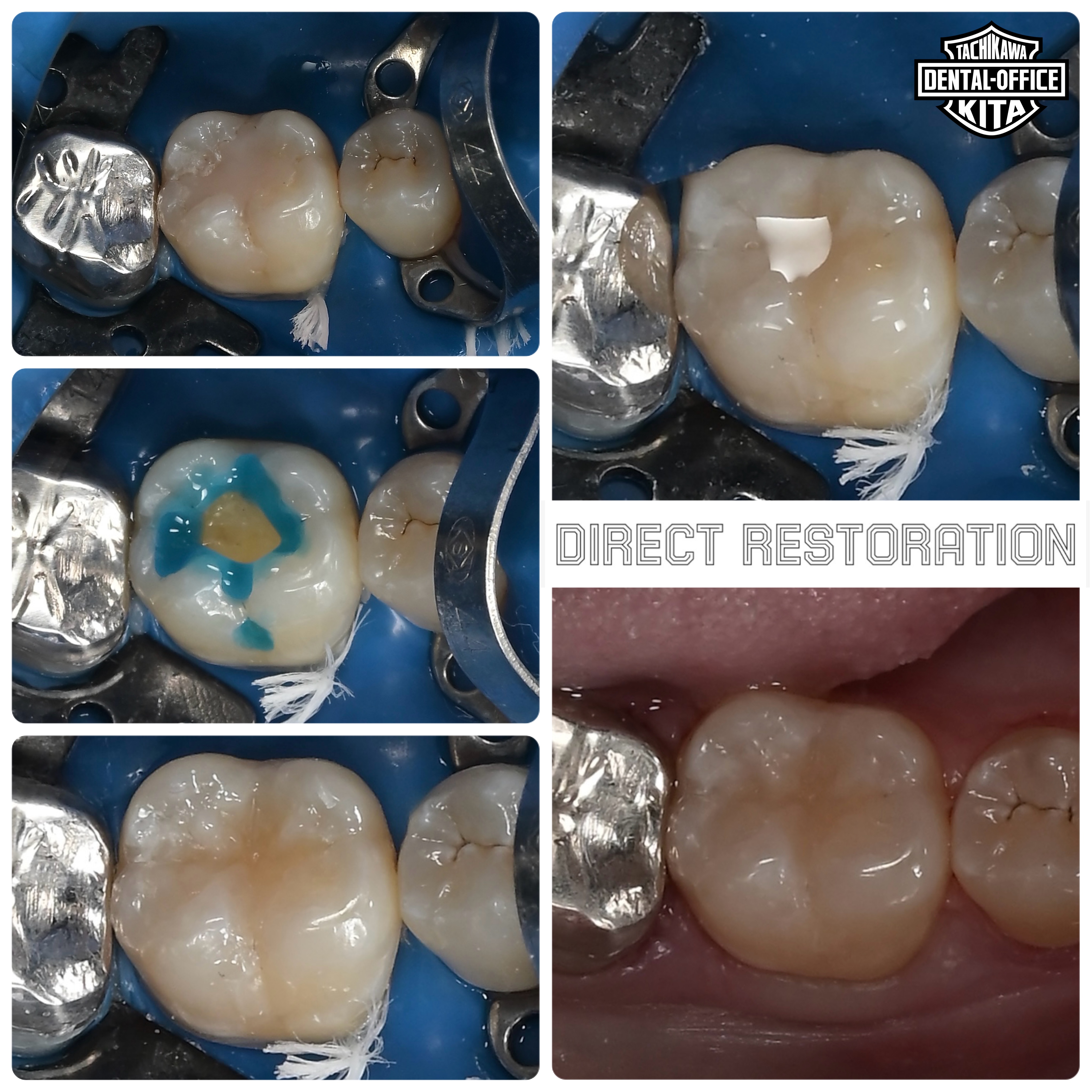 たった45分で歯を復元