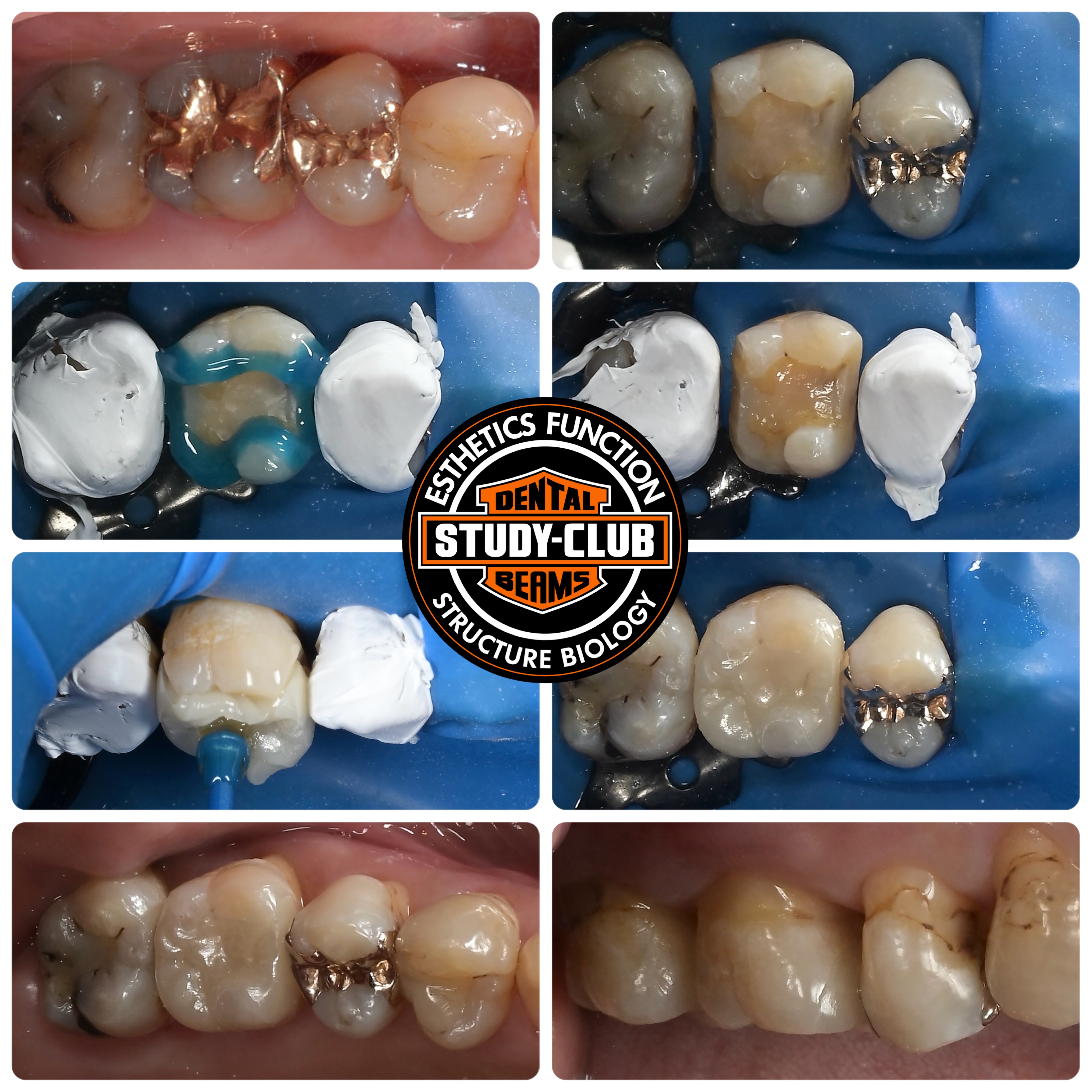 低侵襲虫歯治療　最前線