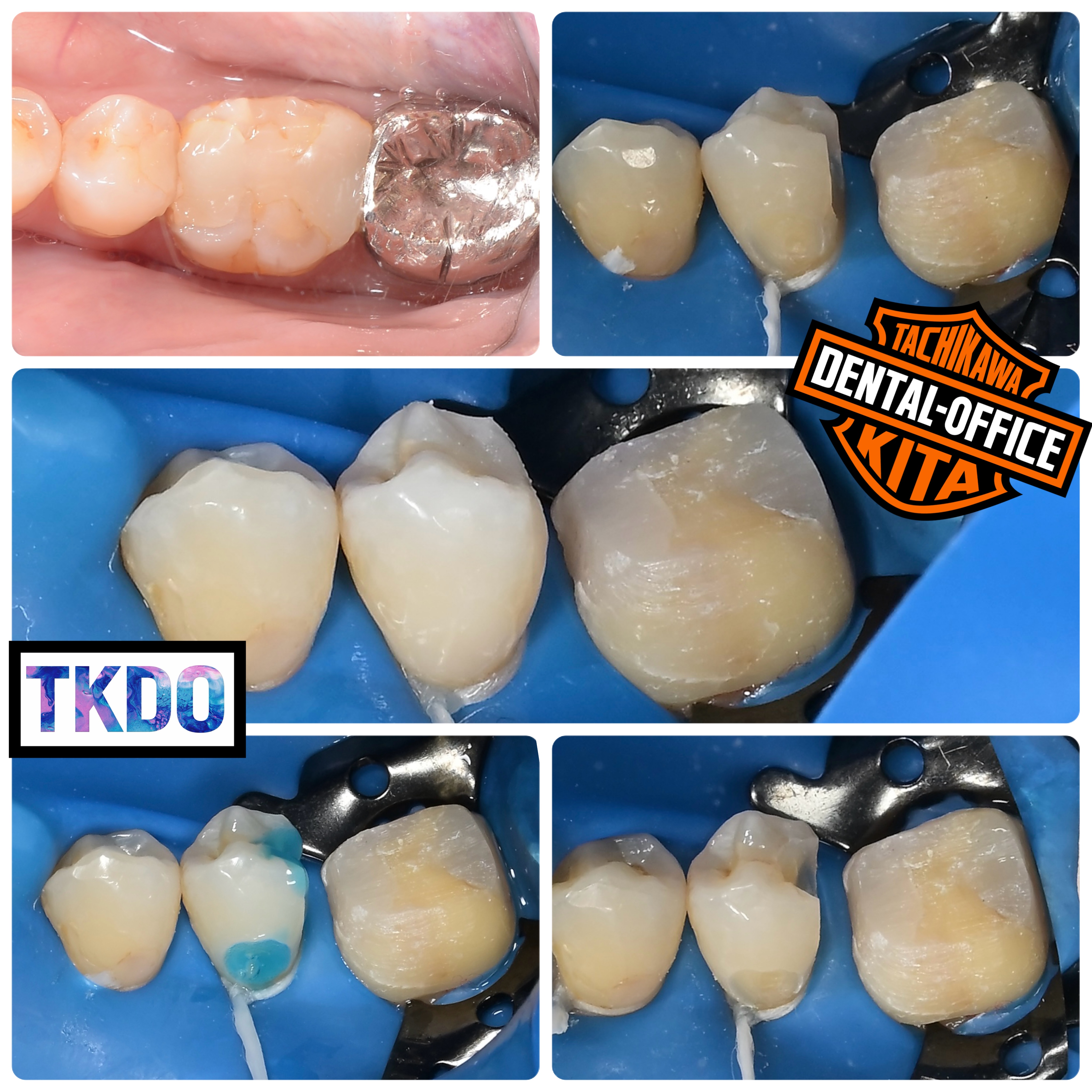 理想的な白い歯を手に入れる