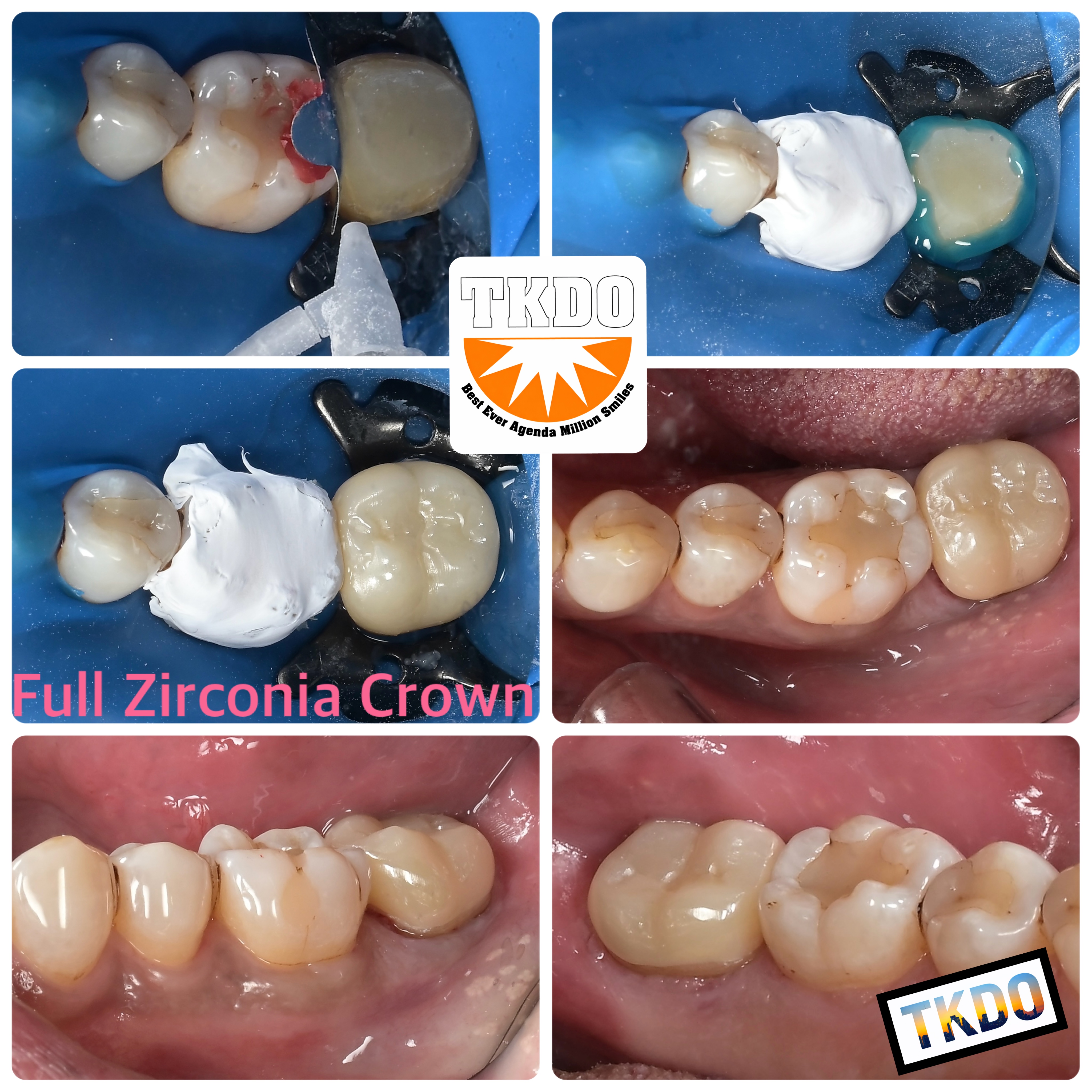 4年経過したら銀歯は外しましょう