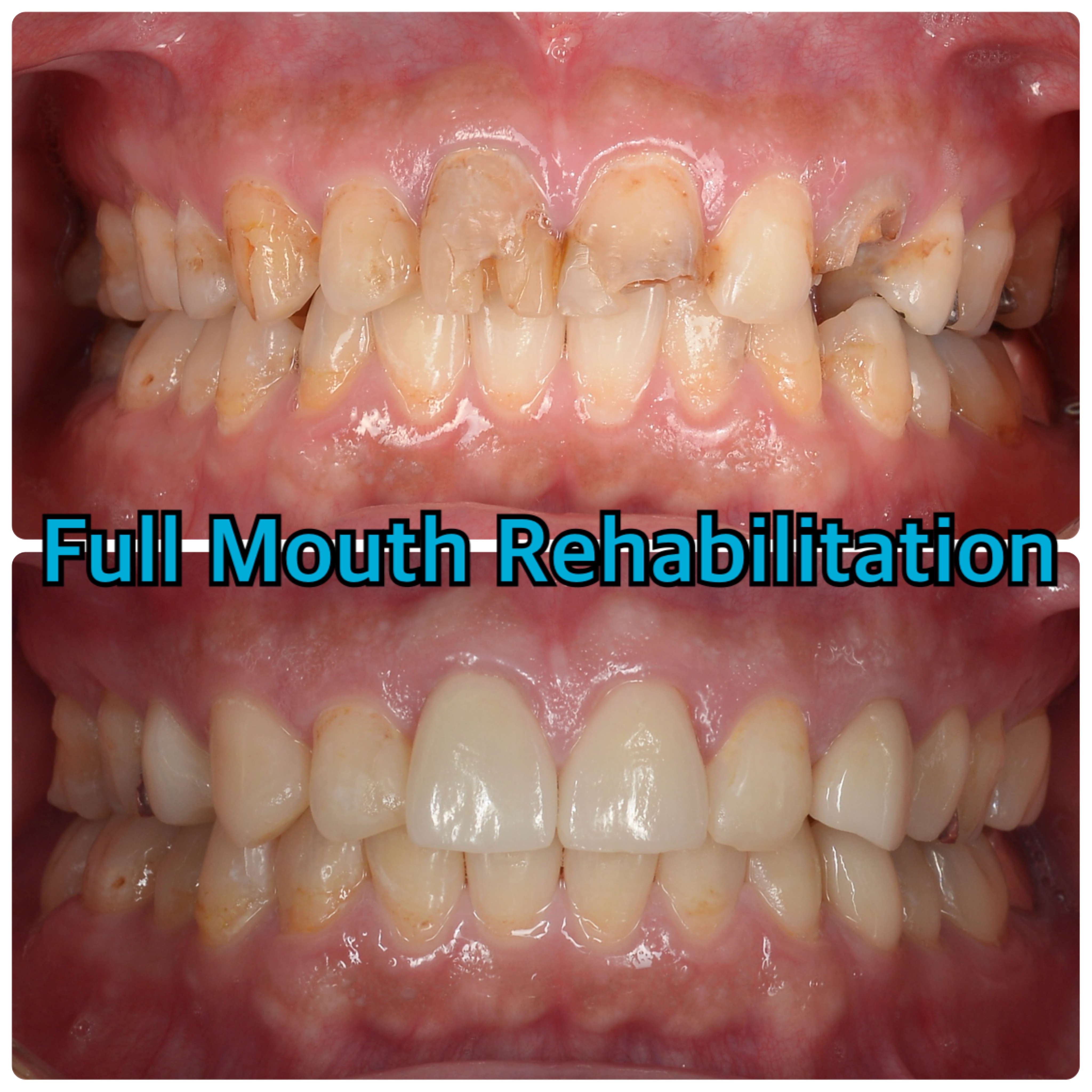 10ヶ月で治療完了