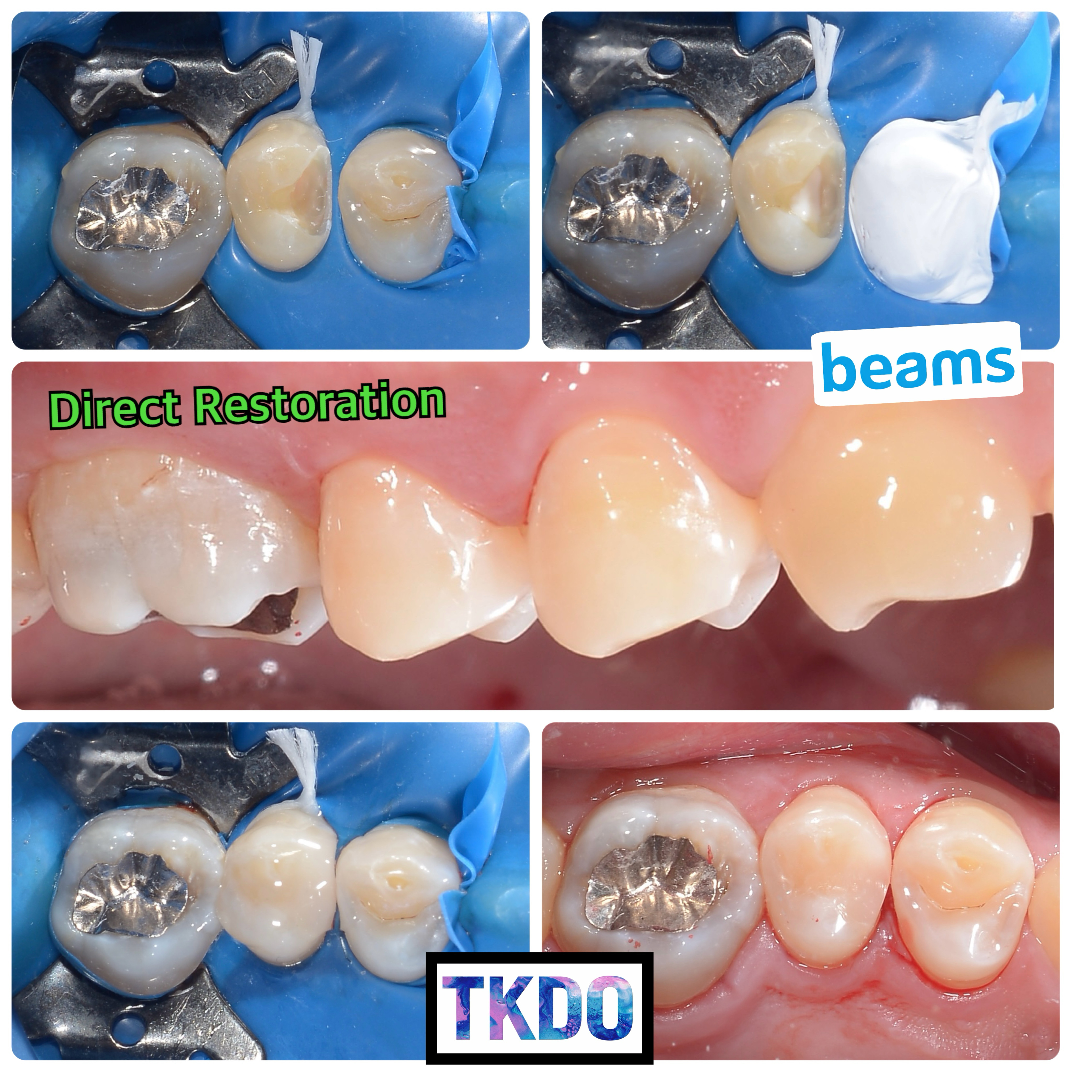 セラミック治療回避してダイレクトボンディング