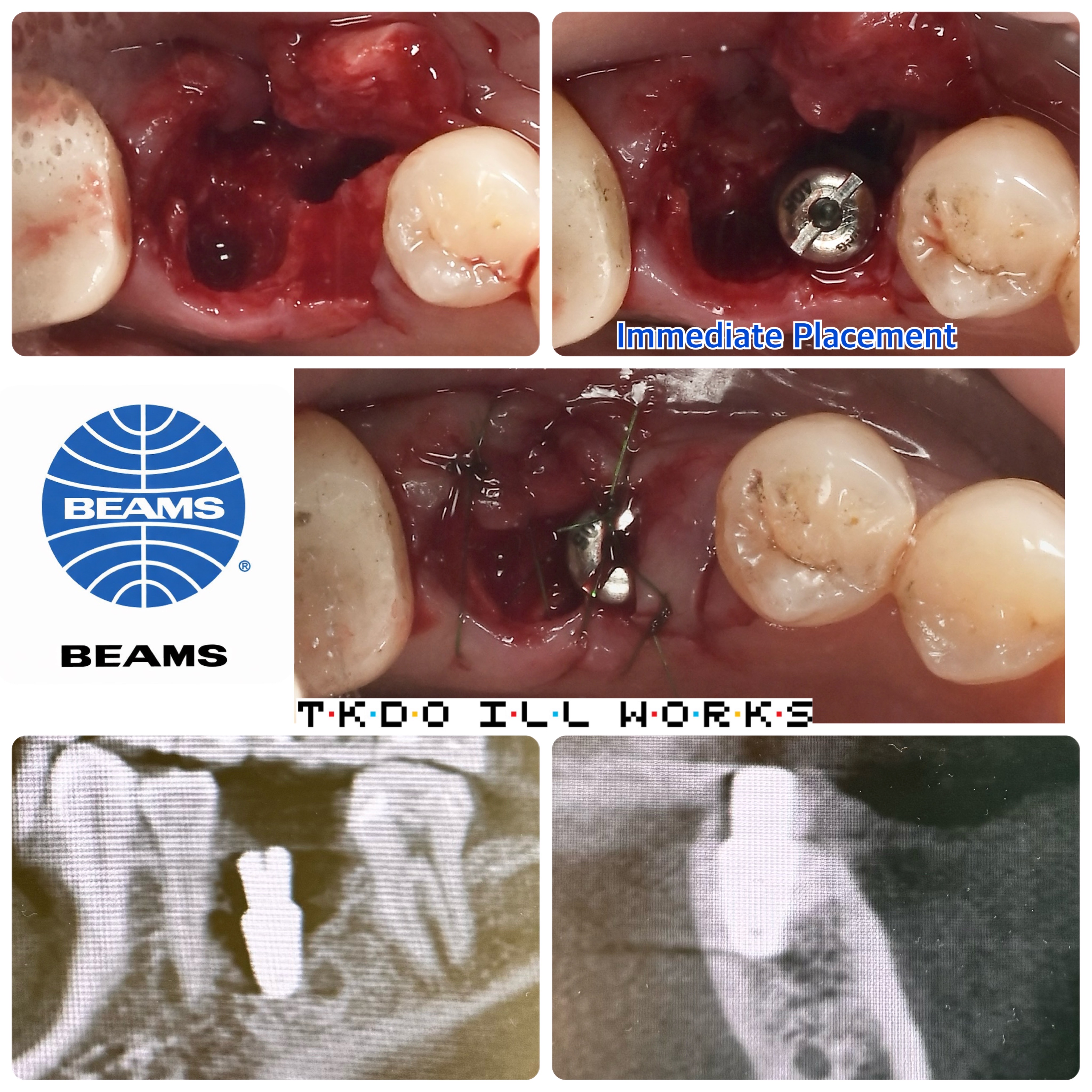 インプラントオペ