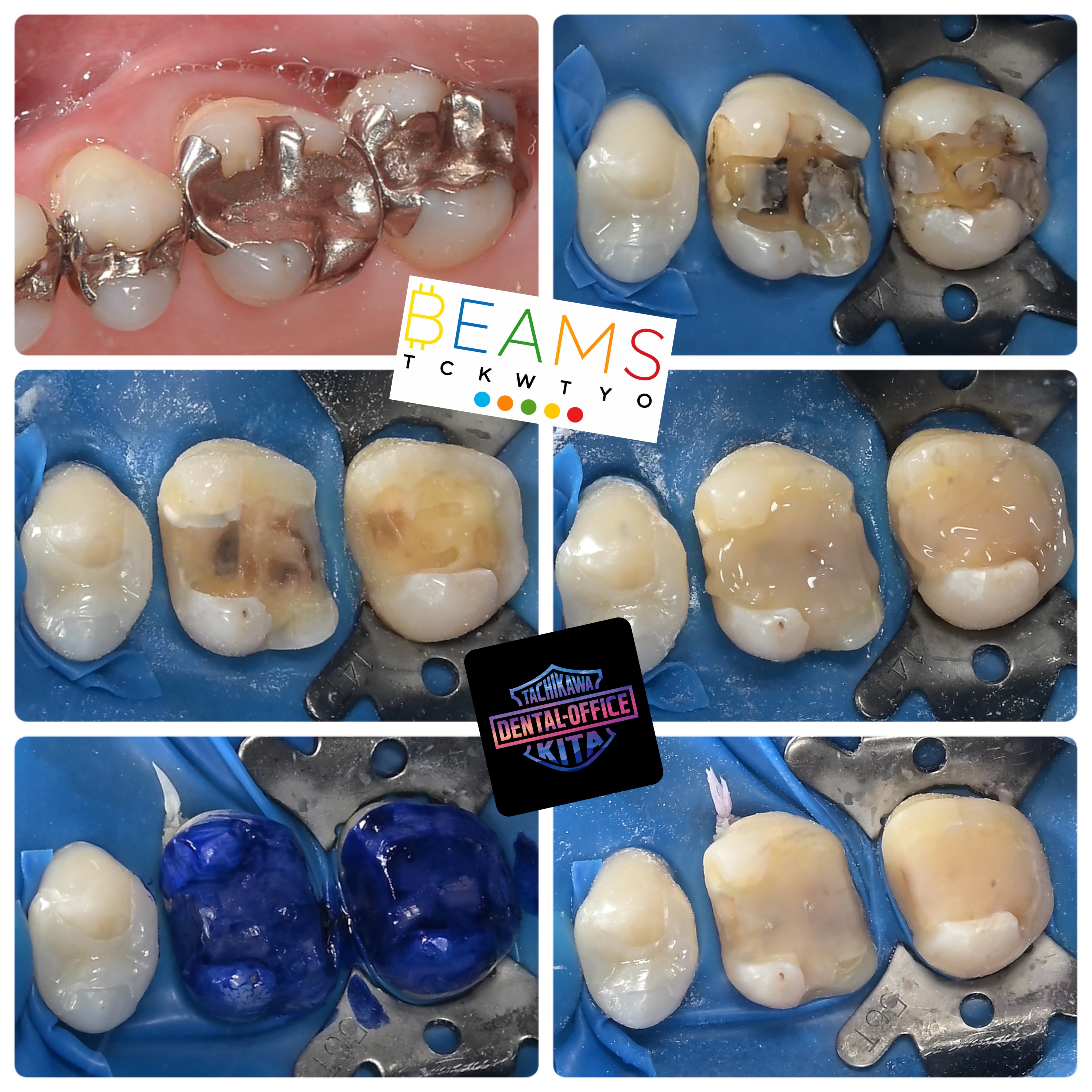 Full Zirconia Onlay