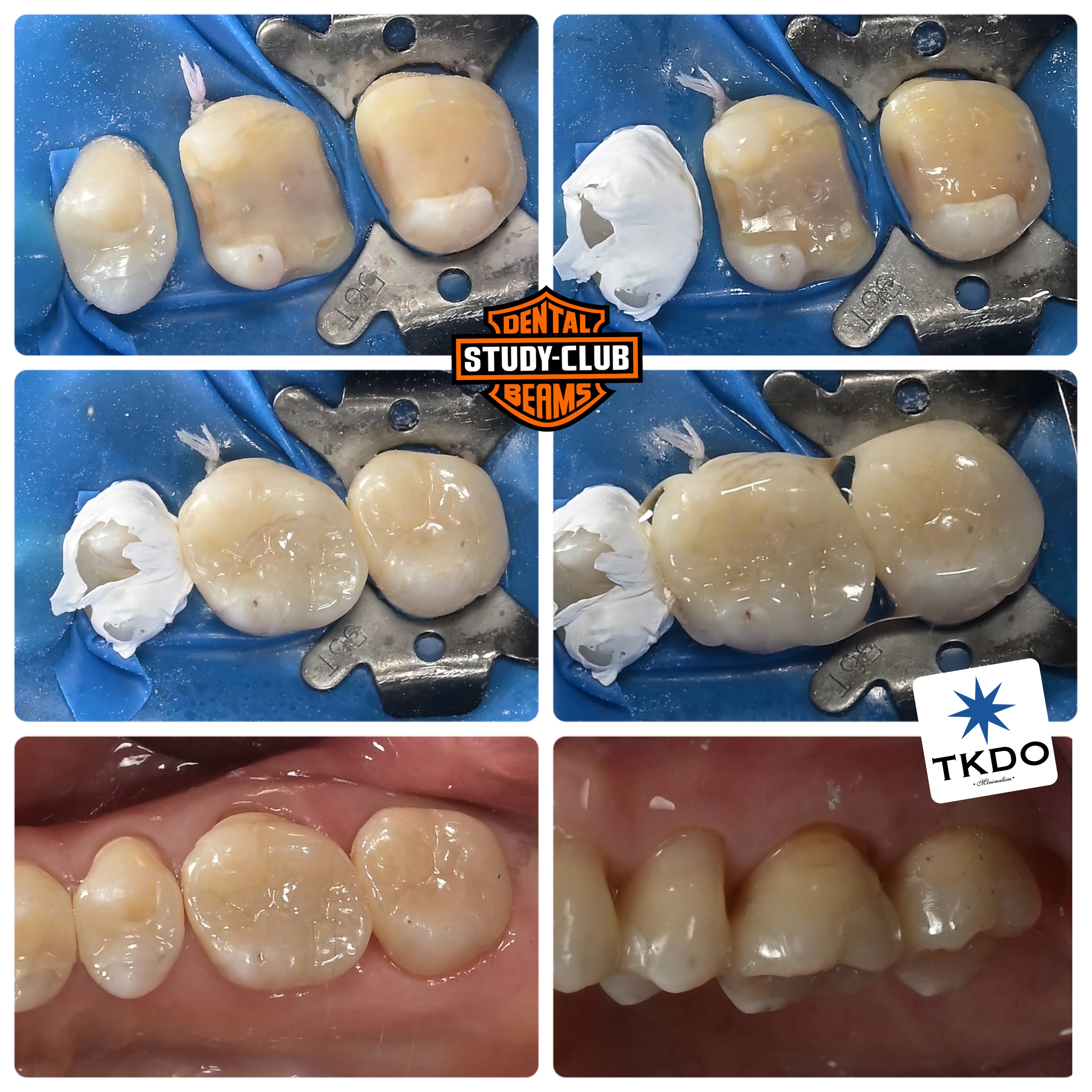 Full Zirconia Onlay
