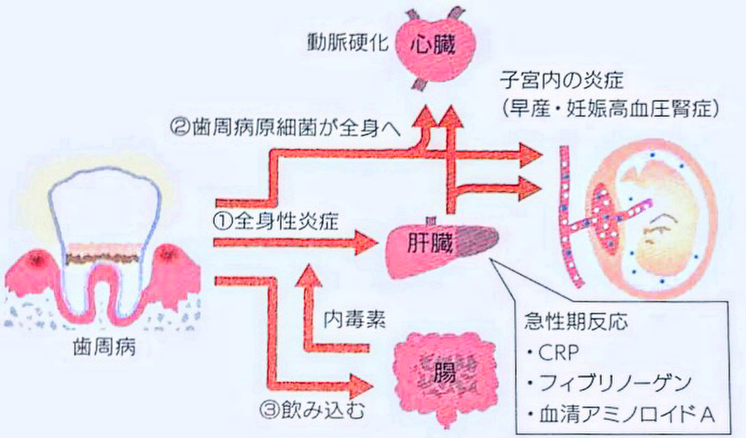 全身疾患は歯周炎から