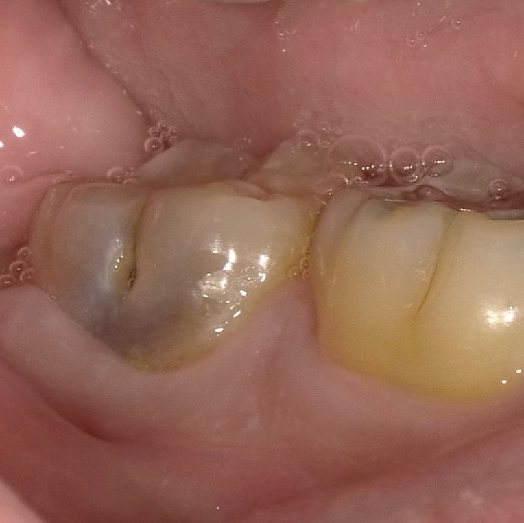 ダイレクトボンディング　歯髄保存