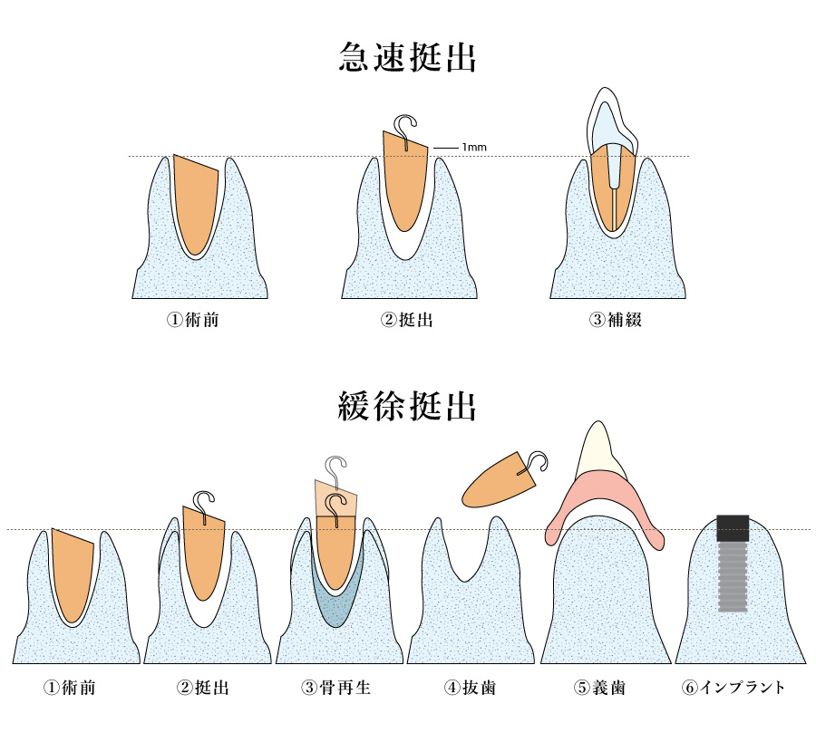 歯の土台も必ずメタルフリーで安心