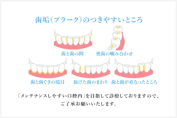 必ず適切に歯を磨いてから受診してください