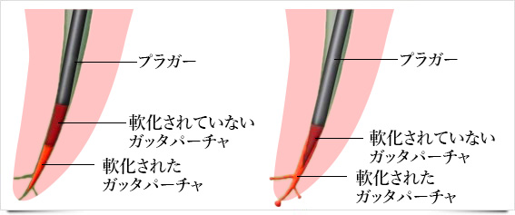 選択肢のある緊密な根管充填