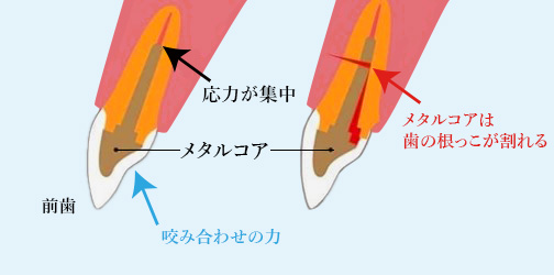 歯根破折やクラウン脱離を予防する支台築造（ファイバーアレンジメント）