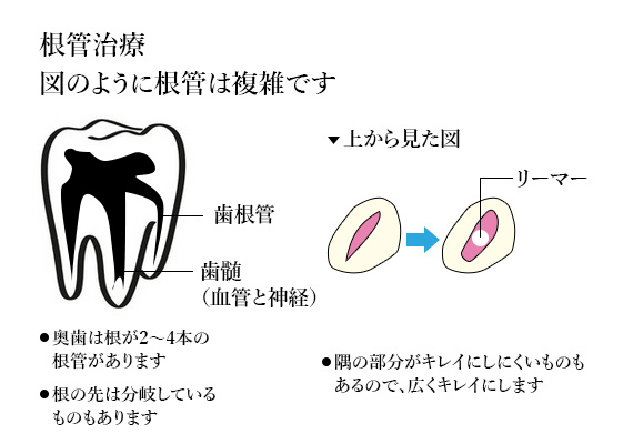 マイクロスコープによる精度の高い抜髄治療