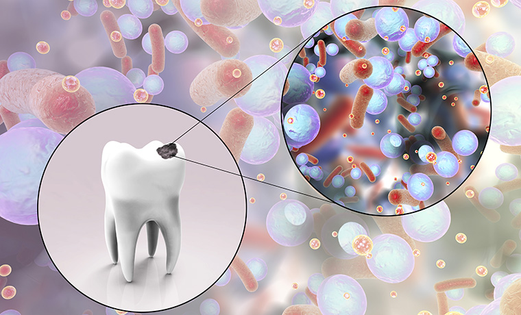 お口の健康を脅かす病気、虫歯