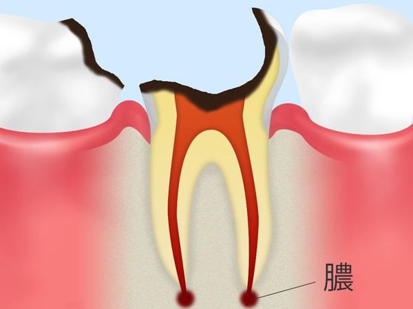 C4歯根まで進んだ虫歯