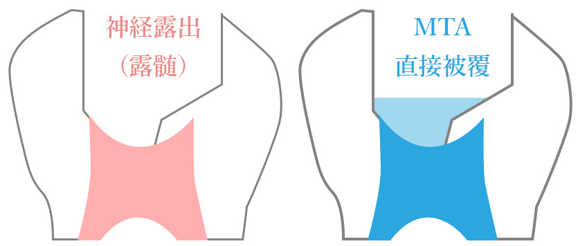 歯科医院を上手に利用して、保存できる歯数を増やしましょう！