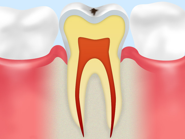C0虫歯のなりはじめ