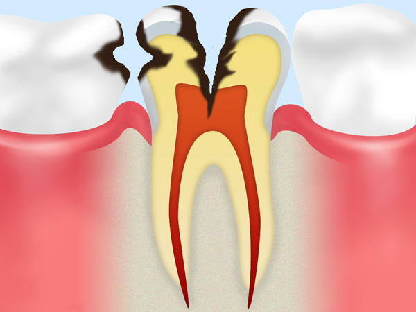 C3神経まで進んだ虫歯