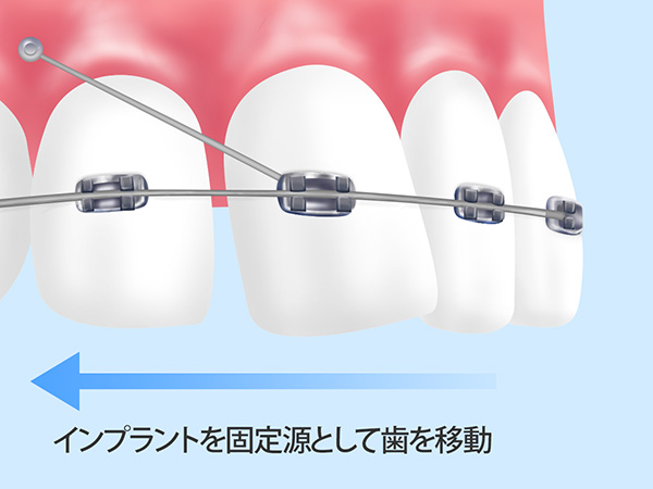 インプラントアンカー埋入