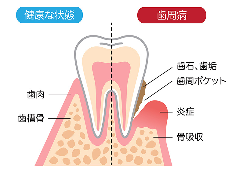 歯周炎の進行・症状